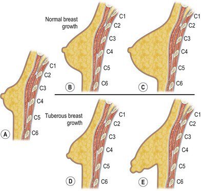 Tuberous Breast infographic