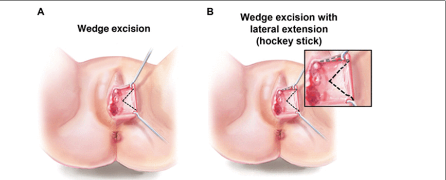 Labiaplasty wedge excision diagram