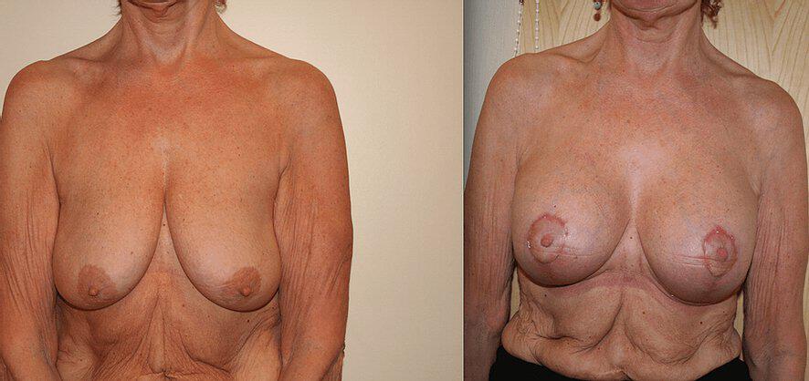 Breast Augmentation With Lift Before & After Image