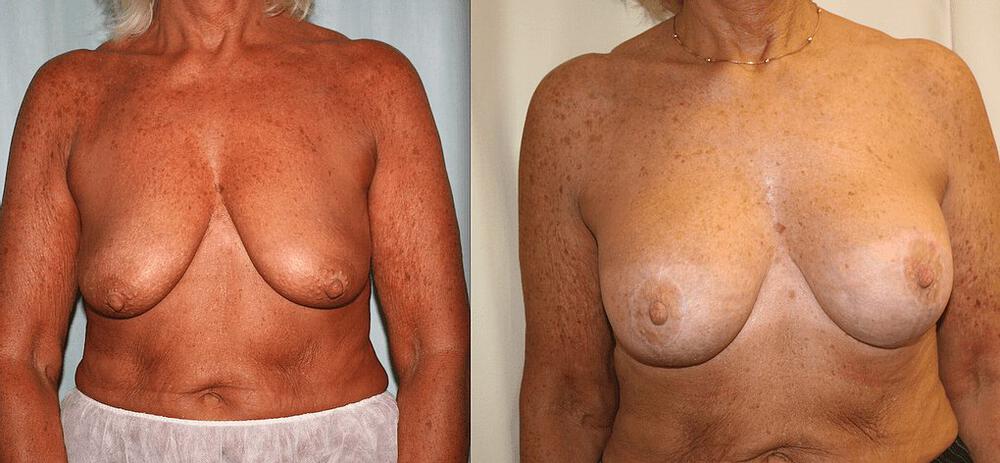 Breast Augmentation With Lift Before & After Image