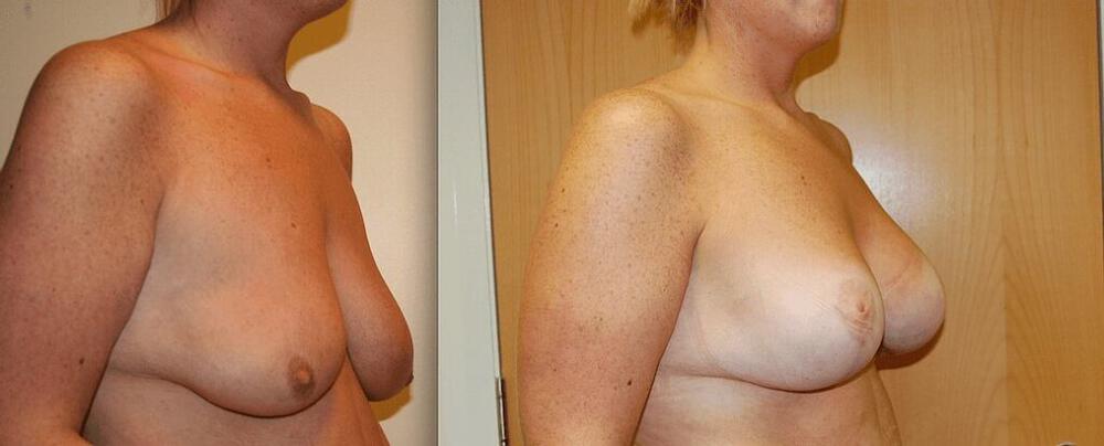 Breast Augmentation With Lift Before & After Image