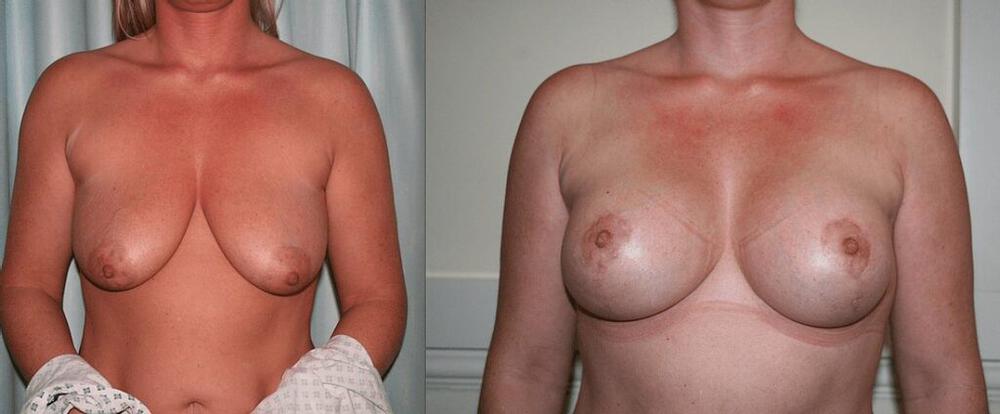 Breast Augmentation With Lift Before & After Image