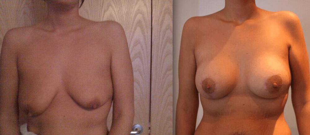 Breast Augmentation With Lift Before & After Image