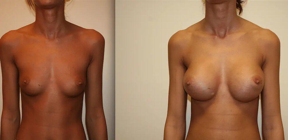 Breast Augmentation Before & After Image