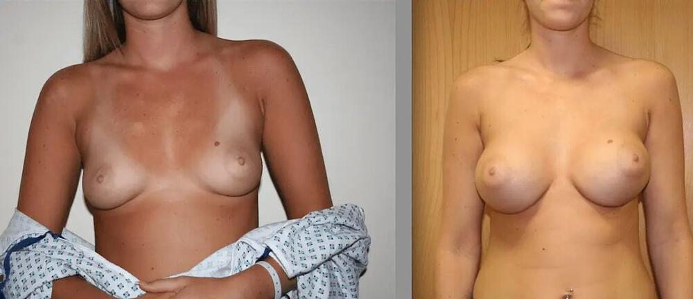 Breast Augmentation Before & After Image