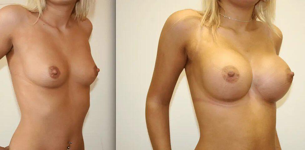 Breast Augmentation Before & After Image