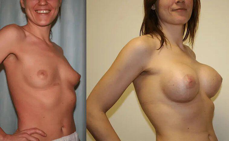 Breast Augmentation Before & After Image