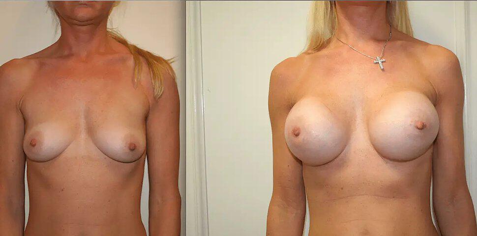 Breast Augmentation Before & After Image