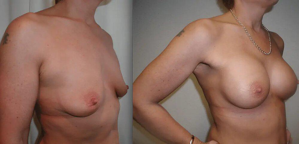 Breast Augmentation Before & After Image