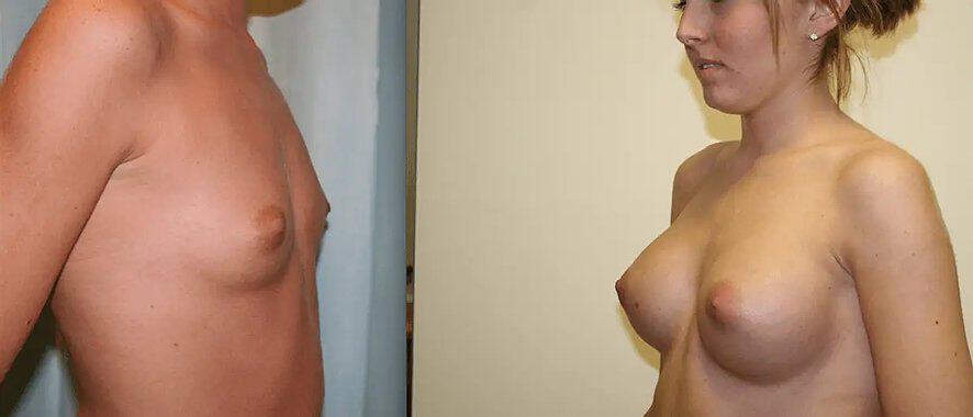 Breast Augmentation Before & After Image