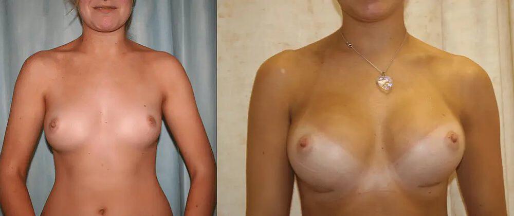 Breast Augmentation Before & After Image