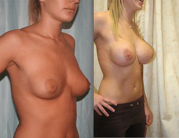 Breast Augmentation Before & After Image
