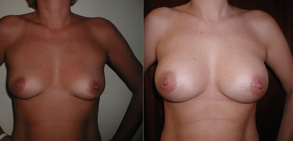 Breast Augmentation Before & After Image