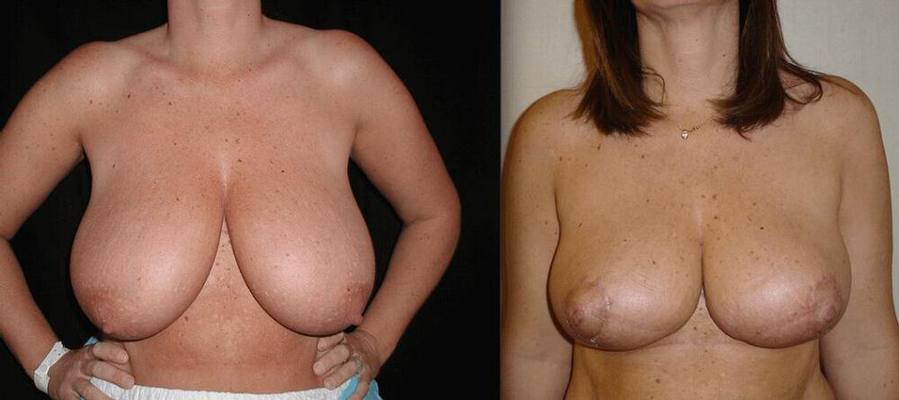 Breast Reduction Before & After Image