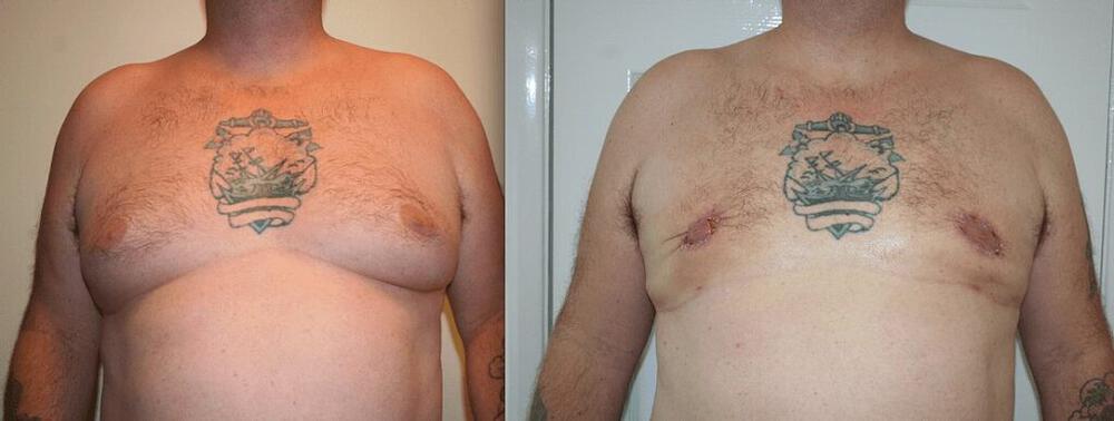 Breast Reduction Manchester