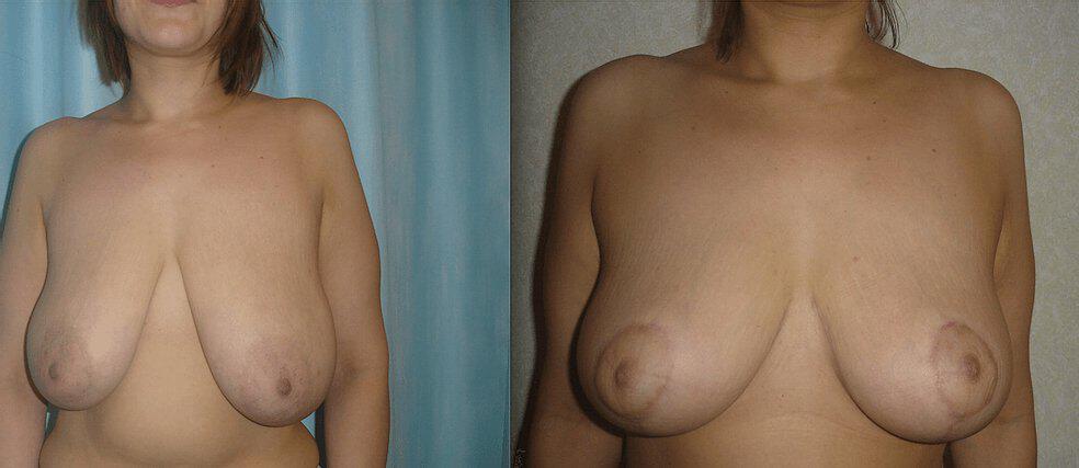 Breast Reduction Before & After Image