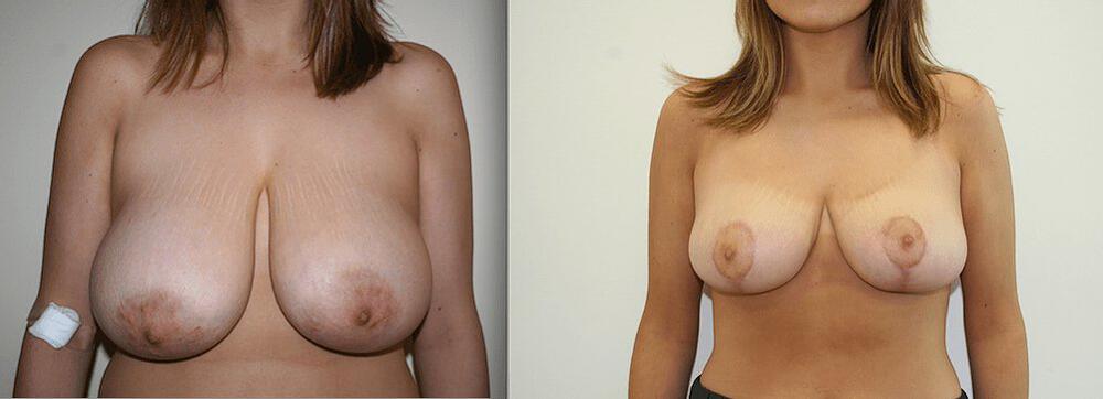 Breast Reduction Before & After Image