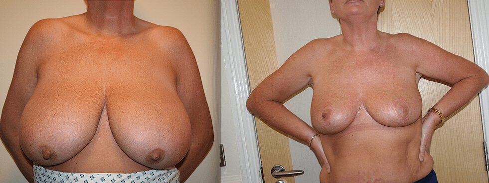 Breast Reduction Before & After Image