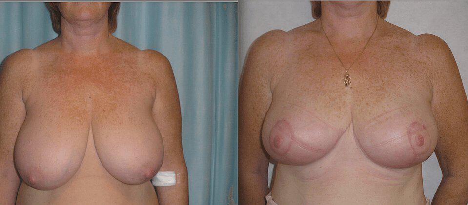 Breast Reduction Before & After Image