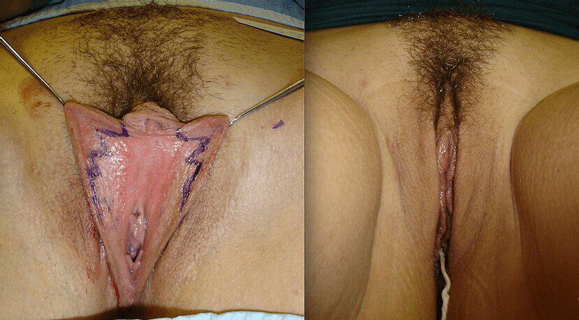 Labiaplasty Before & After Image