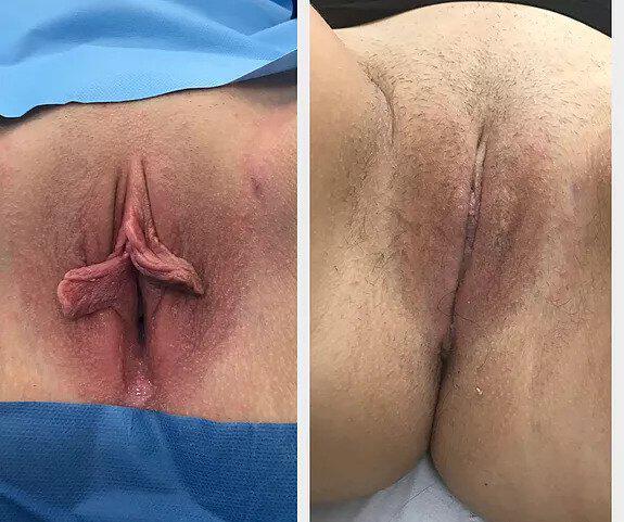 Labiaplasty Before & After Image