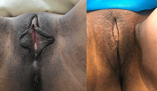 Labiaplasty Before & After Image