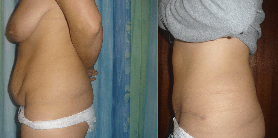 Tummy Tuck Before & After Image