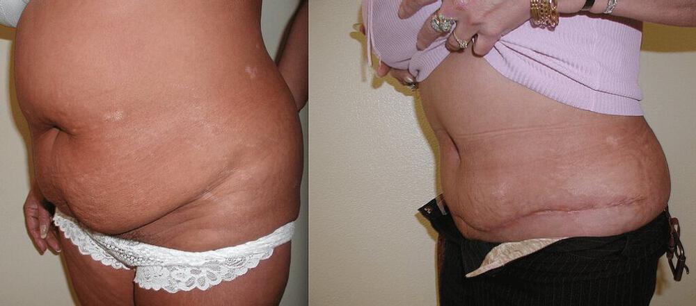 Tummy Tuck Before & After Image