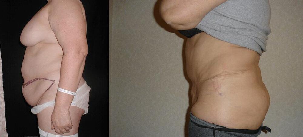 Tummy Tuck Before & After Image