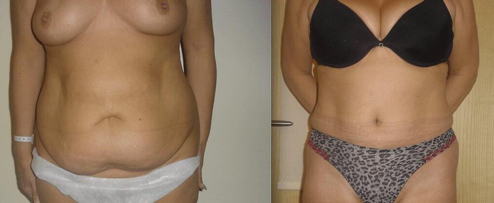 Tummy Tuck Before & After Image