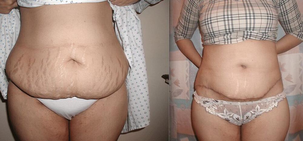 Tummy Tuck Before & After Image