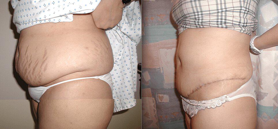 Tummy Tuck Before & After Image