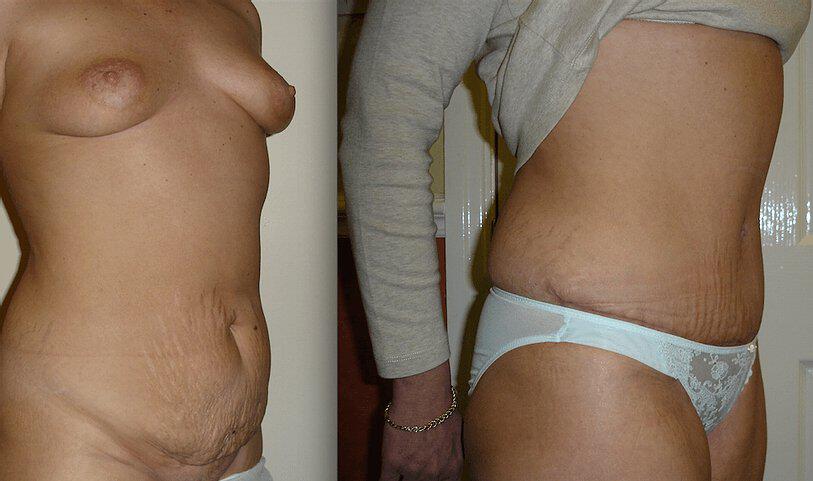 Tummy Tuck Before & After Image