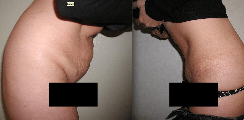 Tummy Tuck Before & After Image