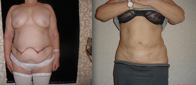 Tummy Tuck Before & After Image