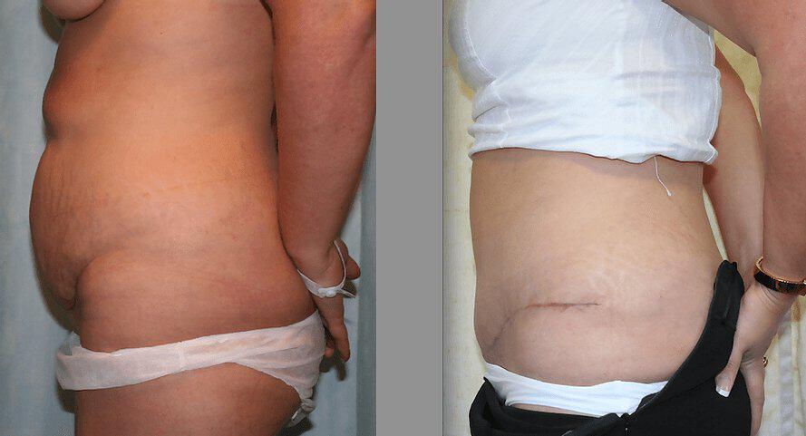 Tummy Tuck Before & After Image