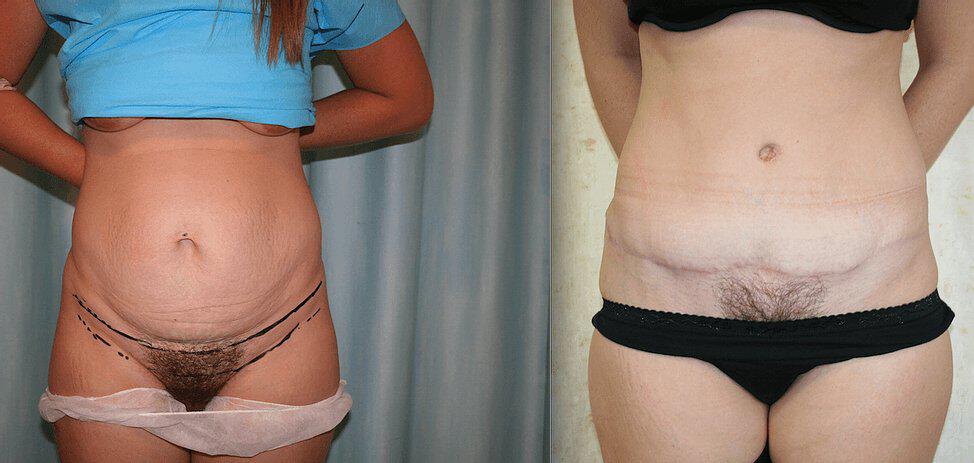 Tummy Tuck Before & After Image