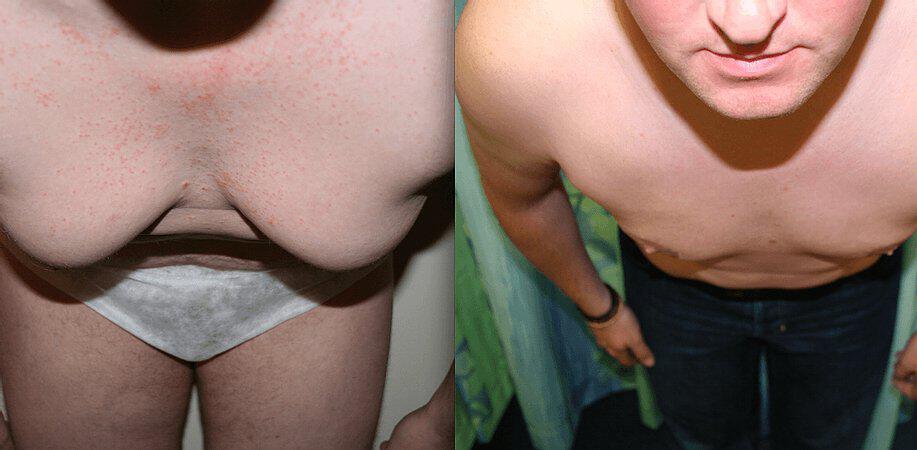 Gynecomastia Before & After Image