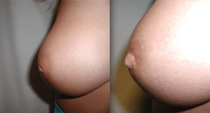 Inverted Nipple Before & After Image