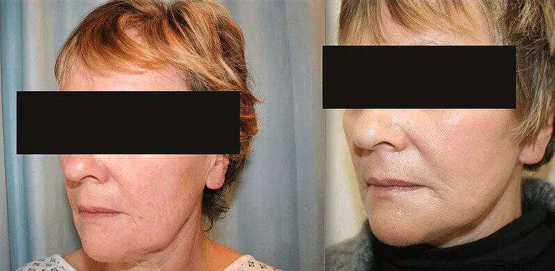 Facelift Before & After Image