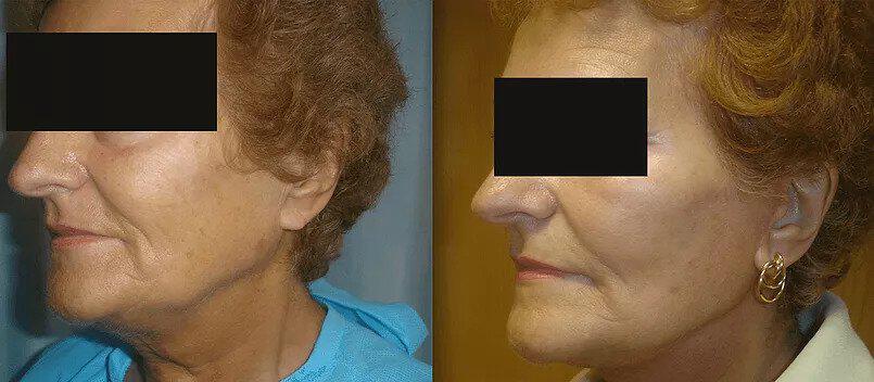 Facelift Before & After Image