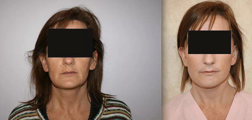 Facelift Before & After Image