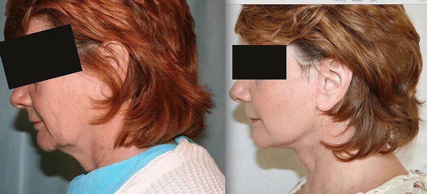 Facelift Before & After Image