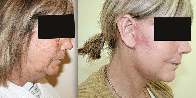 Facelift Before & After Image