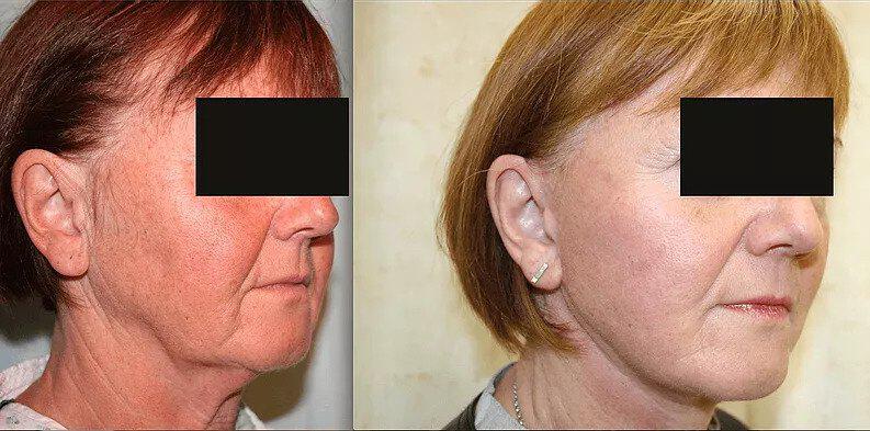 Facelift Before & After Image