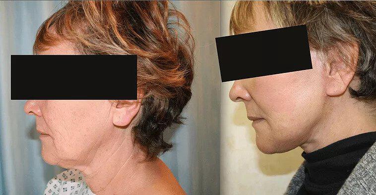 Facelift Before & After Image