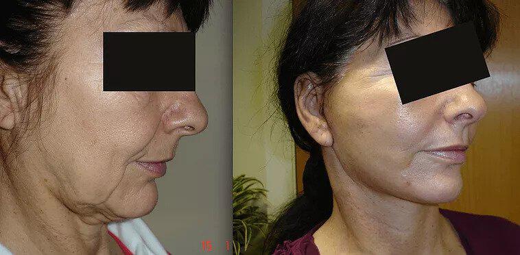 Facelift Before & After Image