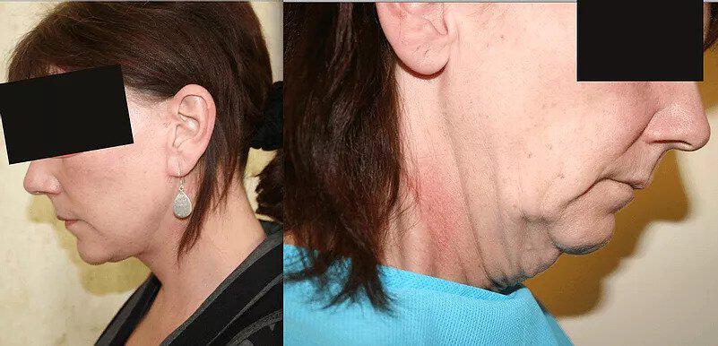 Facelift Before & After Image