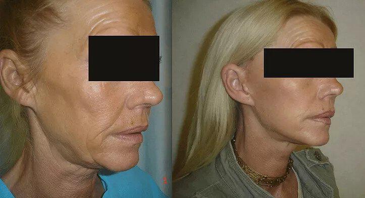 Facelift Before & After Image