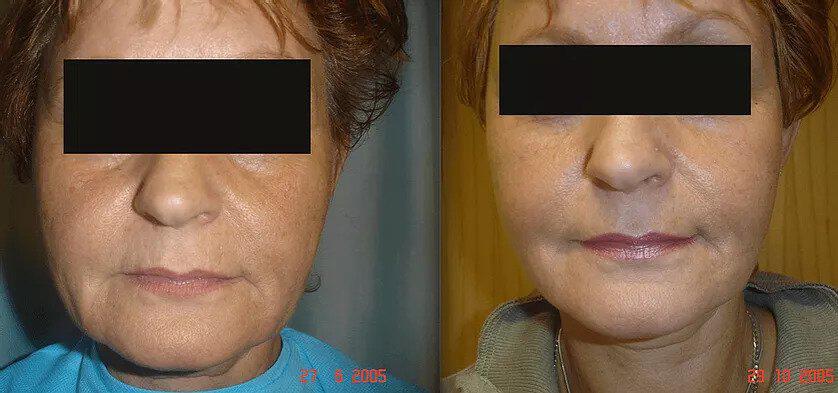 Facelift Before & After Image